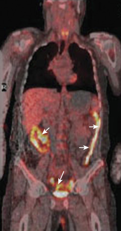 Figure 27-13, Acute inflammation on positron emission tomography with computed tomography (PET/CT). Coronal PET/CT image shows increased fluorodeoxyglucose uptake in the small and large bowel segments (arrows). Acute inflammation was confirmed by colonoscopy in this patient.