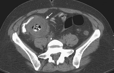 Figure 27-14, Cytomegalovirus colitis. Note significant, concentric wall thickening of the terminal ileum (arrow).