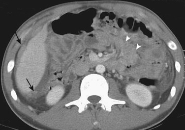 Figure 27-15, Tuberculous peritonitis. Axial computed tomography image shows peritoneal soft tissue nodules (arrows) with small amount of ascites. Small bowel wall thickening is also noted (arrowheads).