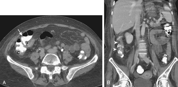 Figure 27-16, Typhlitis in a neutropenic patient. Axial (A) and coronal (B) computed tomography images demonstrate wall thickening of the terminal ileum ( arrow, A ), cecum (C), and ascending colon ( arrowheads, B ).