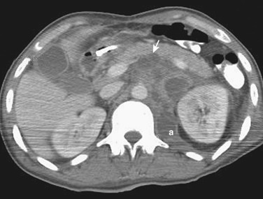 Figure 27-17, Mycobacterium avium complex (MAC) infection. Multiple enlarged retroperitoneal lymph nodes with central low densities (arrow) representing necrosis are typical for MAC infection in this patient with known human immunodeficiency virus infection. There is also a retroperitoneal abscess on the left side (a).