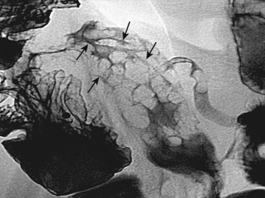 Figure 27-3, Classic cobblestone appearance. Multiple linear ulcerations (arrows) separating islands of normal mucosa.