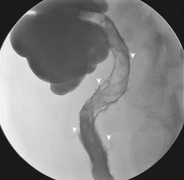 Figure 27-5, Linear ulcers and fissure tracts. Multiple linear ulcers are seen in the strictured terminal ileum. Linear extensions of barium outside the bowel wall (arrowheads) represent fissure tracts. Some of these may evolve into fistulas or abscesses.