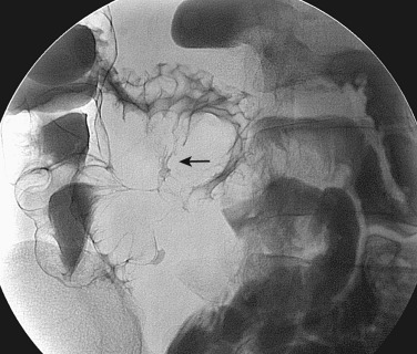 Figure 27-6, Ileoileal fistula. Peroral pneumocolon study demonstrates the linear connection (arrow) between the terminal ileum and a distal segment of ileum representing the fistulous tract.