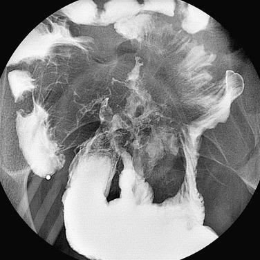 Figure 27-7, Extensive fistula formation involving the small bowel and colon segments in Crohn's disease.