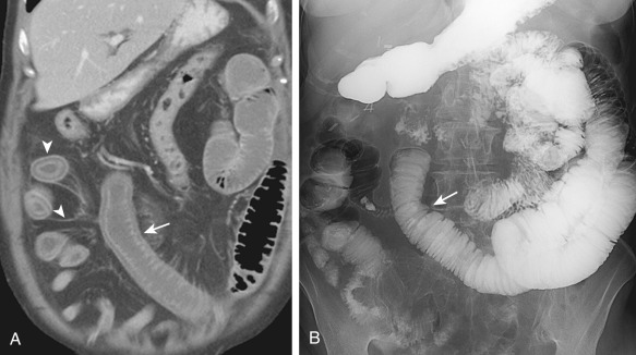 Figure 27-8, Computed tomography enterography after administration of a neutral oral contrast agent (A) shows thick-walled jejunal (arrow) and ileal segments (arrowheads) with mural hyperenhancement and stratification. Small bowel follow-through study (B) demonstrates the thickened, edematous folds in the involved jejunal segment (arrow).