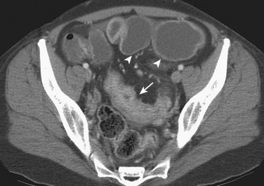 Figure 27-9, Axial computed tomography image shows an inflamed, thick-walled distal ileum segment (arrow) causing dilatation of the proximal small bowel segments (arrowheads), representing bowel obstruction.