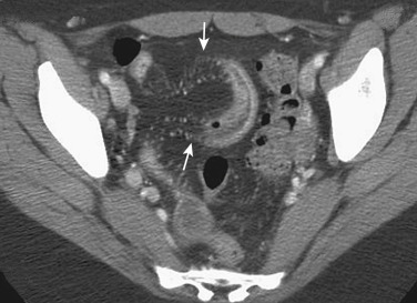 Figure 27-10, “Comb” sign and fibrofatty proliferation. Mesenteric vessels are prominent (arrows), and there is a focal increase in the amount of fat around the inflamed small bowel segment.