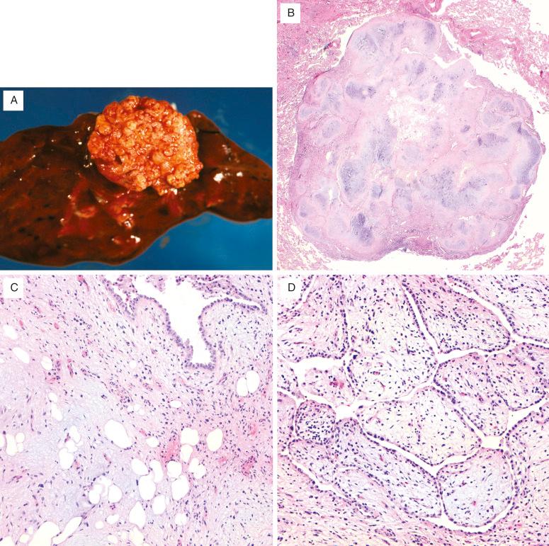 FIG. 31.1, Hamartoma: (A) Hamartoma protruding from cut surface of lung with characteristic white, lobulated surface. Microscopic features. (B) At low magnification, the multilobulated cartilaginous nature of the tumor is obvious. Note how the tumor tears away from surrounding lung tissue, allowing easy removal by the surgeon. (C) Noncartilagenous areas feature benign adipocytes admixed with myxoid fibrovascular tissue and entrapped respiratory epithelium. (D) The edges of the tumor contain nonneoplastic entrapped respiratory-type epithelium. This finding outlines the lesion but should not be mistaken for an epithelial tumor component.