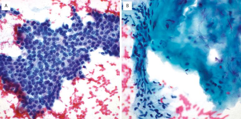 FIG. 31.2, Hamartoma: Cytologic features. Fine-needle aspiration biopsy diagnosis of hamartoma should include sheets of benign respiratory-type epithelium (A) and mesenchymal elements such as cartilage or spindle cells in a myxoid matrix (B) (Papanicolaou stain).