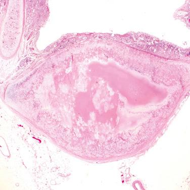 FIG. 31.3, Chondroma: Microscopic features. Unlike a hamartoma, this chondroma arises from the bronchial cartilage and lacks other mesenchymal components and epithelial invaginations.