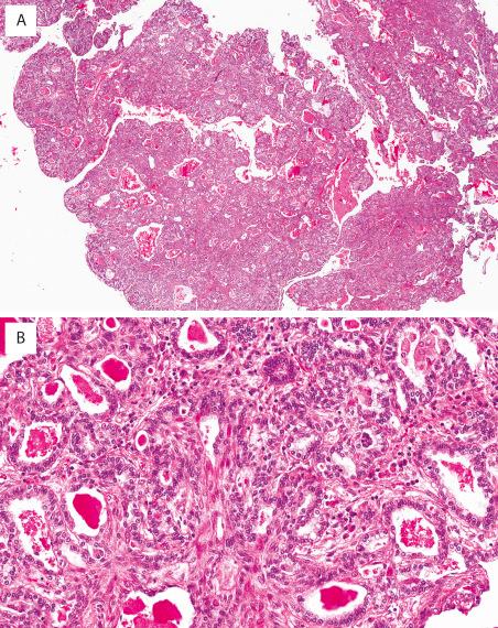 FIG. 31.4, Pneumocytic adenomyoepithelioma. (A) The benign tumor contains areas of solid and more papillary architecture with intermixed bland glandular and spindle cell epithelium. (Photo courtesy of Dr. Carol Farver, Cleveland Clinic, Cleveland, Ohio.) (B) The glandular epithelium is composed of a double layer of pneumocytic cells with mild cytologic atypia and surrounds lumens that have an abundance of eosinophilic, colloid-type material.