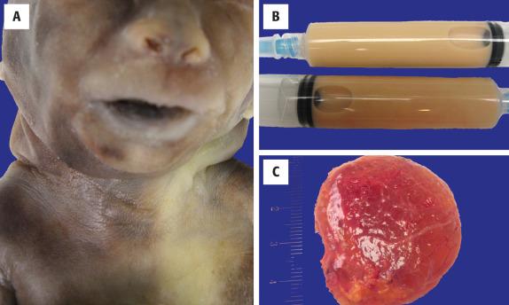 FIGURE 21.1, ( A ) Bilateral cystic masses are noted in the posterior neck of this fetus, affected with Turner syndrome. ( B ) Turbid-milky fluid removed during a fine needle aspiration of a large posterior neck cyst in a child (lymphangioma). ( C ) A translucent mass, showing delicate vessels in the wall of a lymphangioma, filled with clear-watery fluid.