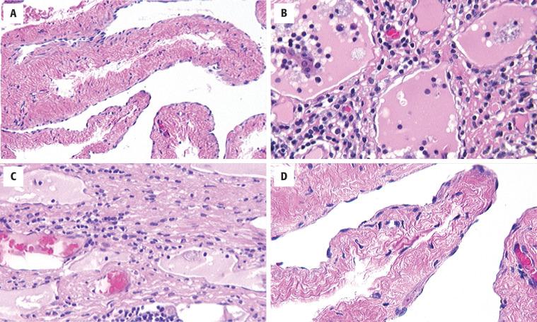 FIGURE 21.3, ( A ) Lymphatic spaces subtended by smooth muscle. ( B ) Lymphoid cells and proteinaceous fluid. ( C ) Lymphoid elements with fibrosis surrounding fluid-filled spaces. ( D ) Flat, attenuated endothelial cells line the cavity.