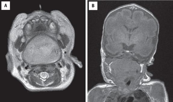 FIGURE 21.4, Magnetic resonance imaging demonstrates a large mass involving the oropharynx, nasopharynx, and neck. ( A ) Axial T2-weighted image. ( B ) Coronal T1-weighted image.