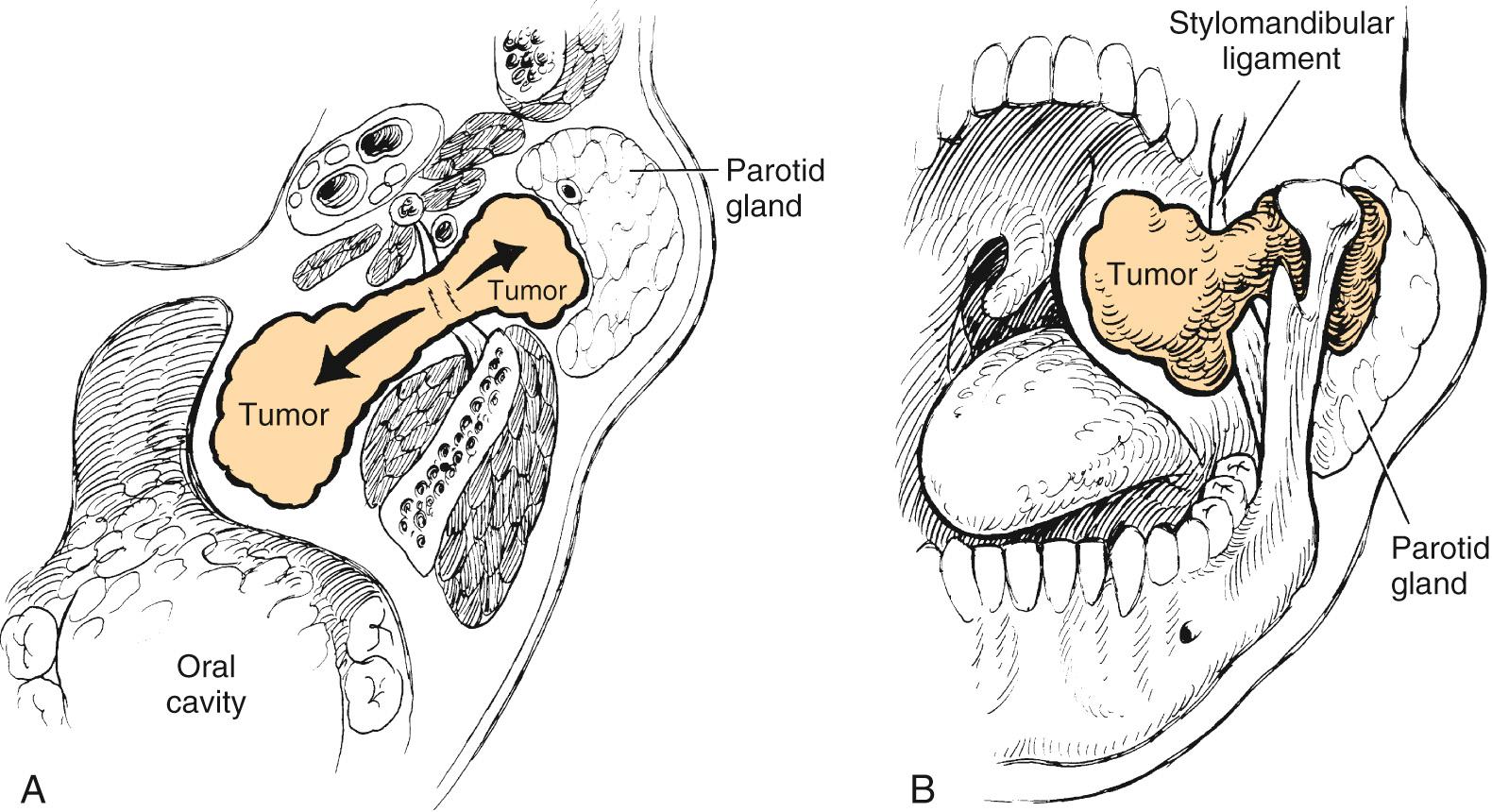 Fig. 84.5, Axial (A) and coronal (B) diagrams of the relationship of dumbbell tumor to the stylomandibular ligament. The dumbbell tumor enters the parapharyngeal space through the stylomandibular membrane between the mandible and the stylomandibular ligament. Arrows indicate potential routes of tumor spread.