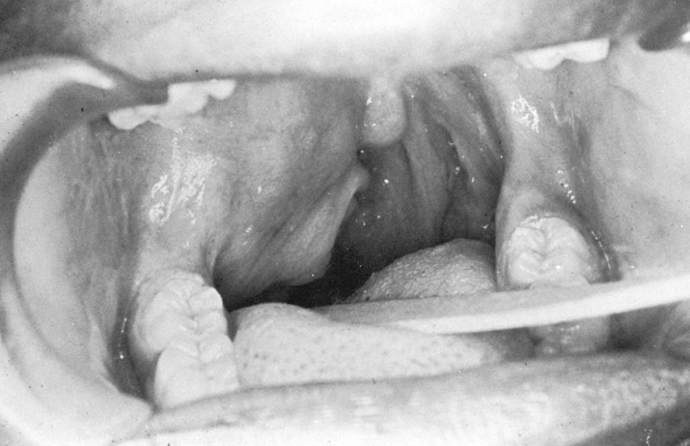 Fig. 84.6, Pleomorphic adenoma of the deep lobe of a parotid gland causes medial displacement of the palate and tonsil.