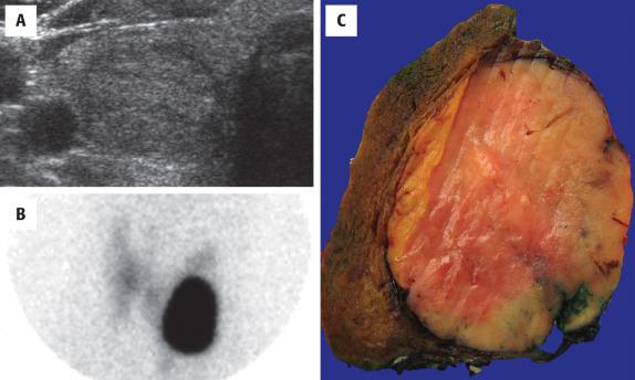 FIGURE 24.1, ( A ) Ultrasound shows an echo-poor halo at the periphery of a solid nodule. ( B ) A “hot” nodule in the left lobe of the thyroid gland demonstrates increased uptake of the radiolabeled 123 I. ( C ) A single encapsulated follicular adenoma with a different cut appearance than the surrounding thyroid parenchyma.