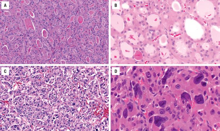 FIGURE 24.12, A series of follicular adenomas with oncocytic cells, showing the diversity that may be seen ( A-D ). There is abundant eosinophilic, granular cytoplasm surrounding nuclei that are generally round and regular, sometimes with prominent nucleoli. ( D ) Profound but focal nuclear pleomorphism may be seen in endocrine organ neoplasms—a finding that does not confer malignancy.