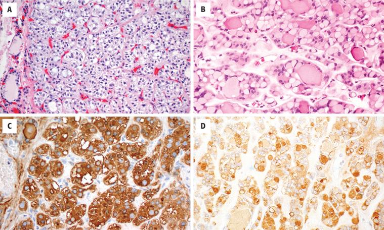 FIGURE 24.13, A follicular adenoma is composed exclusively of clear cells in this case ( A ), although colloid production can still be highlighted with a thyroglobulin ( C ). ( B ) A signet-ring adenoma is composed of cells with a large cytoplasmic vacuole that compresses the nucleus. ( D ) Thyroglobulin highlights the vacuoles in a signet-ring adenoma.