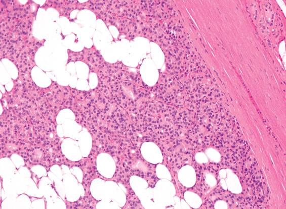 FIGURE 24.15, A lipoadenoma contains fat cells interspersed between the follicles.