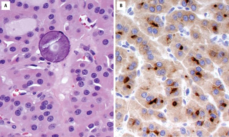 FIGURE 24.16, ( A ) Colloid has become inspissated and calcified, but the nuclei are round and regular in this oncocytic follicular adenoma. ( B ) Thyroglobulin may help to confirm the follicular derivation of tumors with limited to absent colloid production.