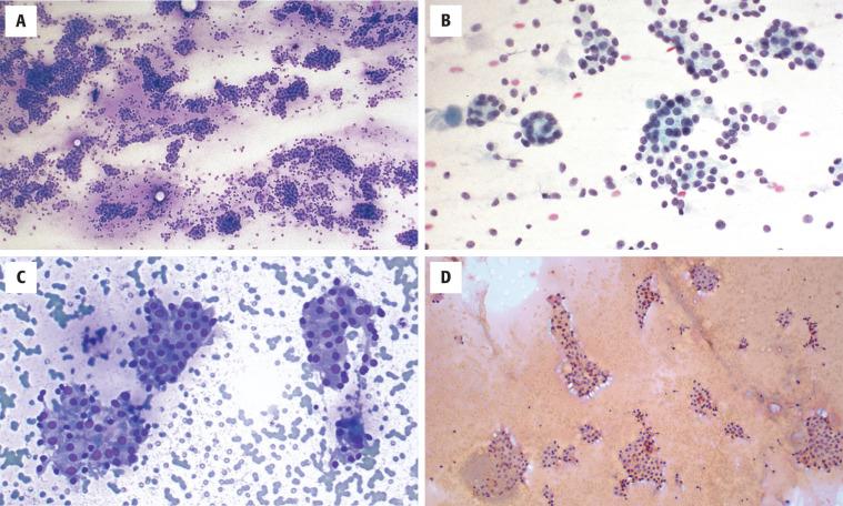 FIGURE 24.17, Fine needle aspiration of follicular adenomas usually generates a Bethesda category IV: “follicular neoplasm” or “suspicious for follicular neoplasm.” Cellular smears with syncytial groups of uniform and monotonous cells are seen. Scant colloid is present ( A and C , air-dried, Diff-Quik stain; B and D , alcohol-fixed, Papanicolaou stain). Note the oncocytic appearance of the cells in C and D .