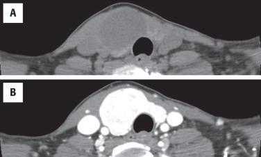 FIGURE 24.2, ( A ) Computed tomography scan showing a well-defined nodule in the right thyroid gland, brightly enhancing with contrast ( B ).