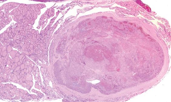 FIGURE 24.3, A variably thick fibrous connective tissue capsule surrounds a follicular adenoma showing oncocytic change. Central degeneration is a result of previous fine needle aspiration.