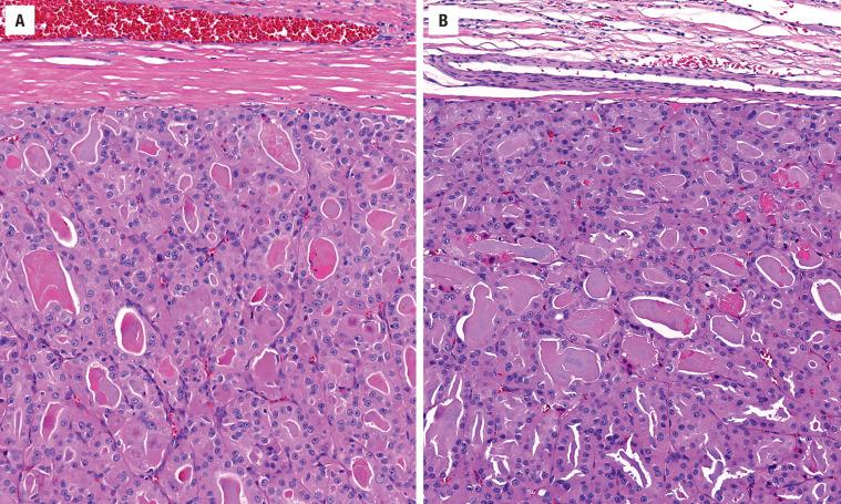 FIGURE 24.6, ( A ) A well-formed, thick capsule surrounds this oncocytic tumor. ( B ) There is a very thin capsule, exhibiting an elongated vessel.