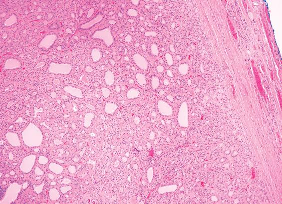 FIGURE 24.9, A follicular adenoma with normofollicular architecture showing easily identified colloid. The tumor is distinctly different from the surrounding parenchyma.