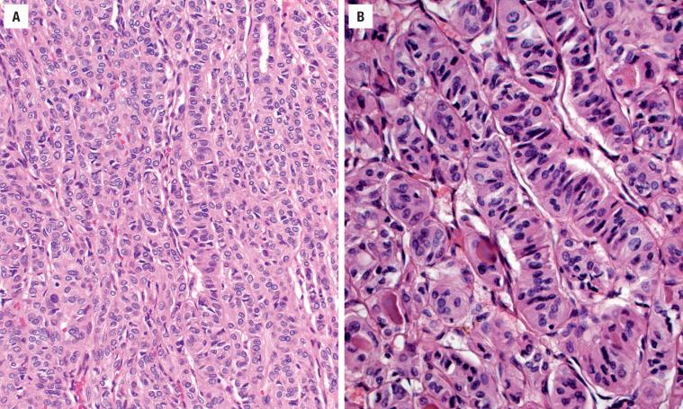 FIGURE 24.10, ( A ) A trabecular-to-insular architecture is noted in this adenoma with scant colloid. ( B ) There is no intratumoral fibrosis, although vascular channels are noted surrounding the trabeculae.