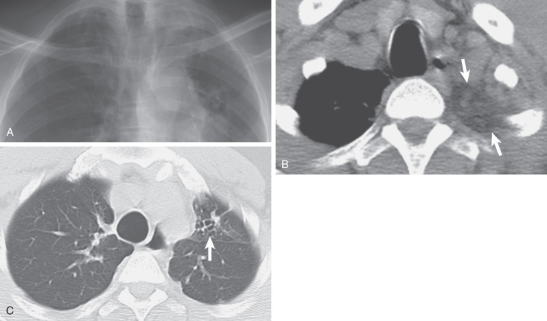 Fig. 73.2, Apical cap from previous tuberculosis. (A) Magnified view from a posteroanterior chest radiograph depicts asymmetric pleural thickening of >1 cm of the left apex. There is associated parenchymal scarring and volume loss of the left upper lobe. (B) CT image shows that the left apical thickening is almost entirely resulting from an accumulation of extrapleural fat (arrows). (C) CT image through the lung apices demonstrates left upper lobe volume loss and bronchiectasis (arrow), in keeping with a history of remote tuberculosis.