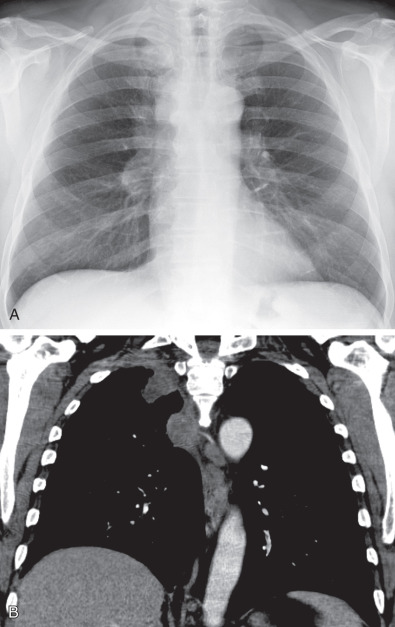 Fig. 73.4, Pancoast tumor. (A) Posteroanterior chest radiograph and (B) coronal contrast-enhanced CT scan show a soft tissue mass in the right lung apex and thickening of the right paratracheal stripe representing lymph node metastases.