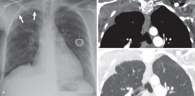 Fig. 73.5, Radiation fibrosis. (A) Posteroanterior chest radiograph demonstrates asymmetric right apical pleural thickening (arrows) postradiation therapy for breast cancer. Note is made of a smaller right breast shadow. (B) Composite image with coronal reformatted CT scans in soft tissue and lung windows shows the radiographic opacity is composed of extrapleural fat, pleural thickening, and reticulations from pulmonary fibrosis. Note right upper lobe volume loss.