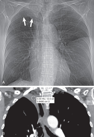 Fig. 73.6, Loculated pleural effusion post right upper lobectomy. (A) Scout view of CT demonstrates right apical opacity mimicking pleural thickening (arrows) . (B) Coronal reformatted CT image shows loculated right apical pleural fluid with density of 0 Hounsfield units.