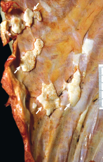 Fig. 73.7, Asbestos-related pleural plaques in an asbestos miner. Autopsy specimen shows numerous pearly white pleural plaques along the costal parietal pleura (arrows).