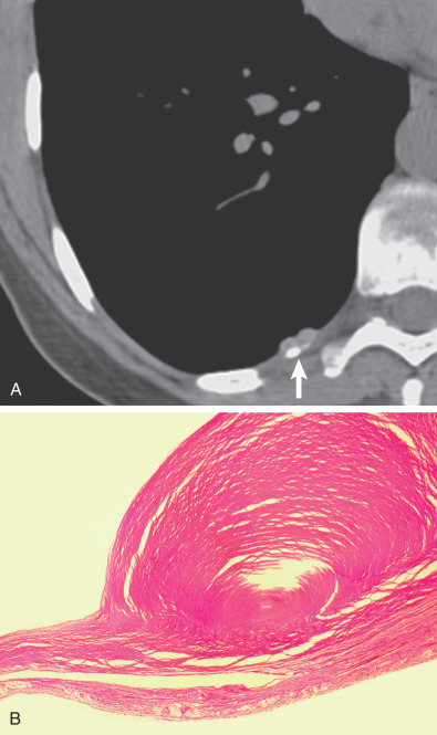 Fig. 73.8, Pleural plaque. (A) Magnified view from a CT image at the level of the right lower lobe shows a single pleural plaque that is partially calcified (arrow). The patient presented with a spontaneous pneumothorax, for which pleurectomy was performed. There was no history of trauma. (B) Pathology section shows the full thickness of the pleural plaque. The collagenous plaque demonstrates the typical acellular basket-weave appearance.