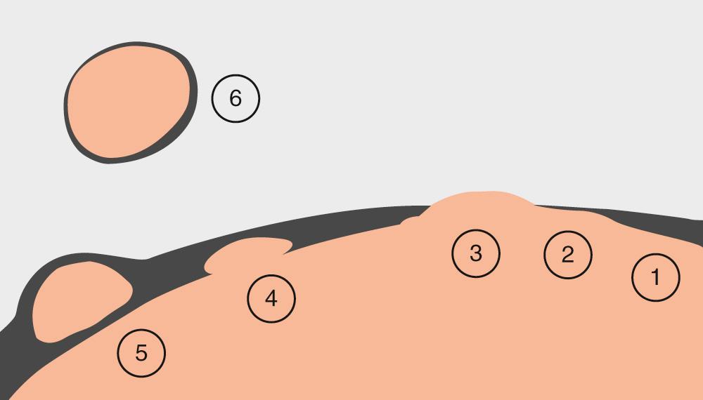 Fig. 34.1.2, Capsular characteristics of pleomorphic adenoma. 1. Thick capsule; 2. Thin capsule; 3. Incomplete capsule; 4. Capsule penetration; 5. Pseudopod; 6. Satellite nodule.