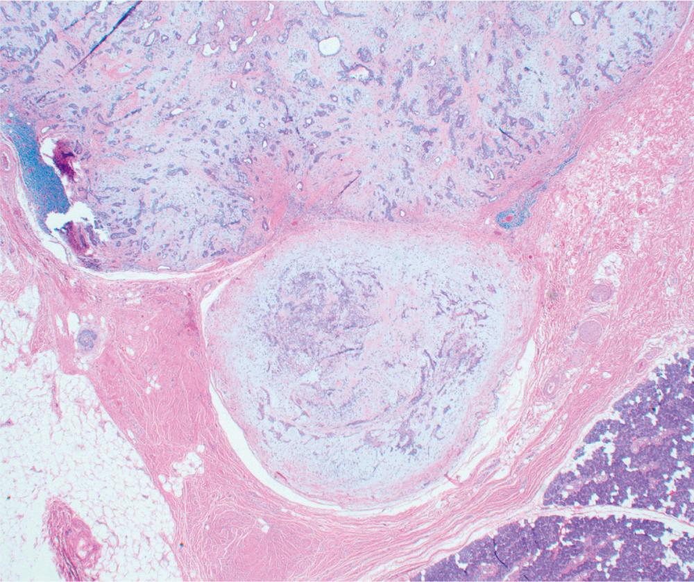 Fig. 34.1.3, Sections of a pleomorphic adenoma showing pseudopod formation consisting of acini in lobules embedded in myxoid matrix protruding into the adjacent soft tissue. Capsule thickness ranges from thin to thick. There are scattered lymphocytes at the periphery of some of the lobules, inside the capsule. (H&E ×200)