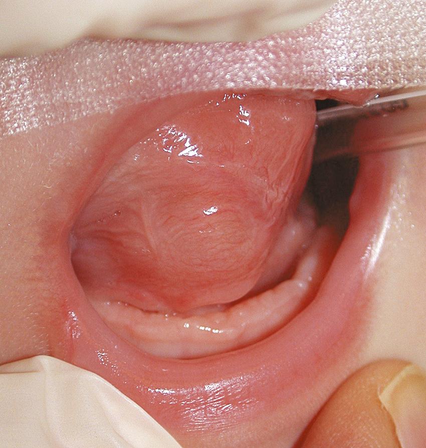 Fig. 90.2, Duplication cyst involving the tongue.