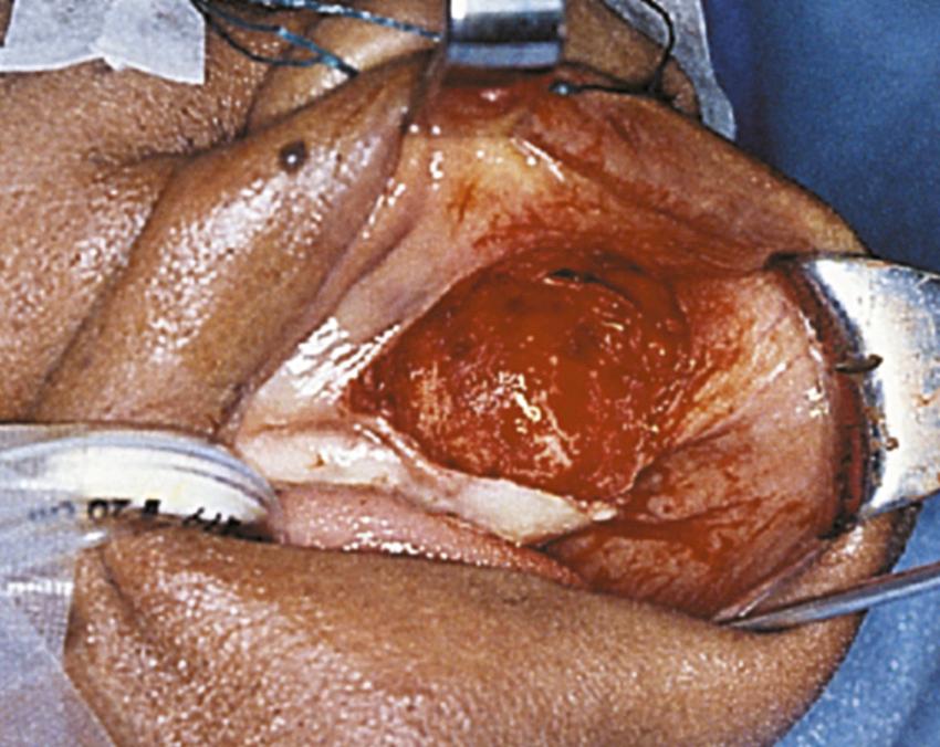 Fig. 90.3, Sublabial approach to a nasoalveolar cyst.