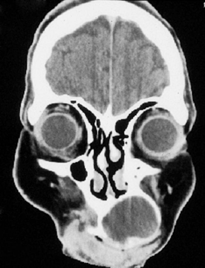 Fig. 90.4, Remodeling of the maxilla associated with a nasoalveolar cyst.