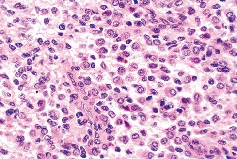 Fig. 25.11, High-power view of localized TGCT showing slight variation in size of the constituent cells.