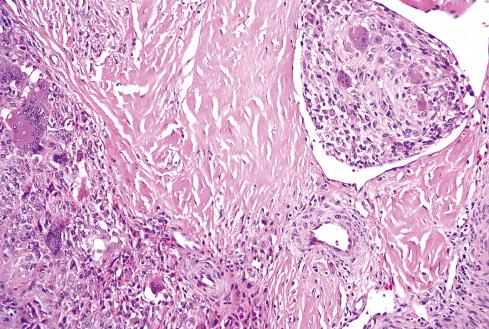 Fig. 25.12, Focus of tumor in vein in localized TGCT. This feature does not necessarily indicate malignancy.