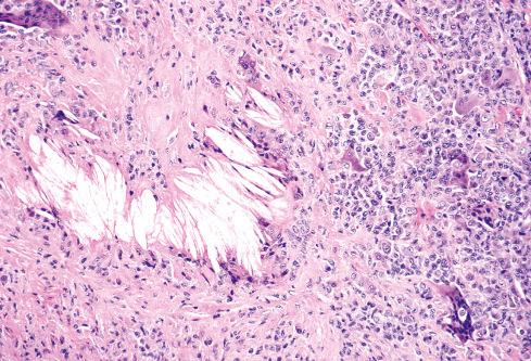 Fig. 25.13, Cholesterol clefts in localized TGCT.