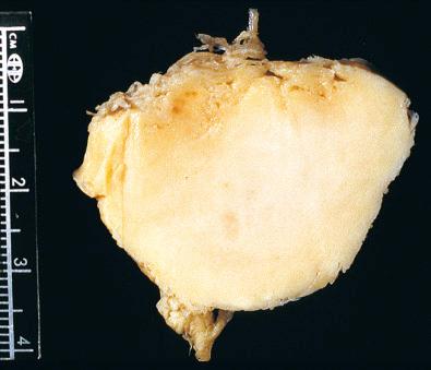 Fig. 25.3, Gross appearance of localized TGCT.