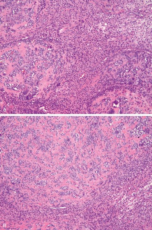 Fig. 25.6, Regional variation in localized TGCTs. Tumor can be solidly cellular with giant cells ( A ), solidly cellular without giant cells ( B ), and lipidized ( C ).