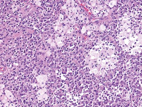 Fig. 25.7, Punctate collections of foam cells in localized TGCT.