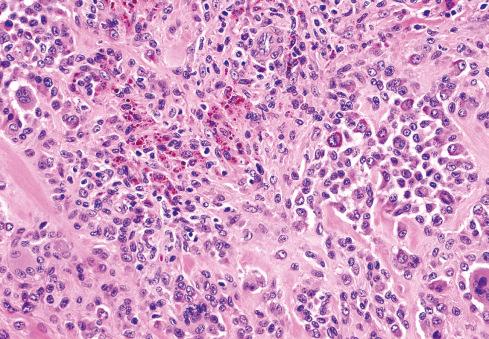 Fig. 25.9, Hemosiderin deposits in localized form of TGCT.